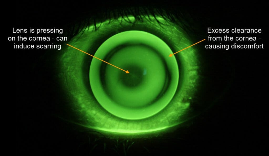 keratoconus contact lenses