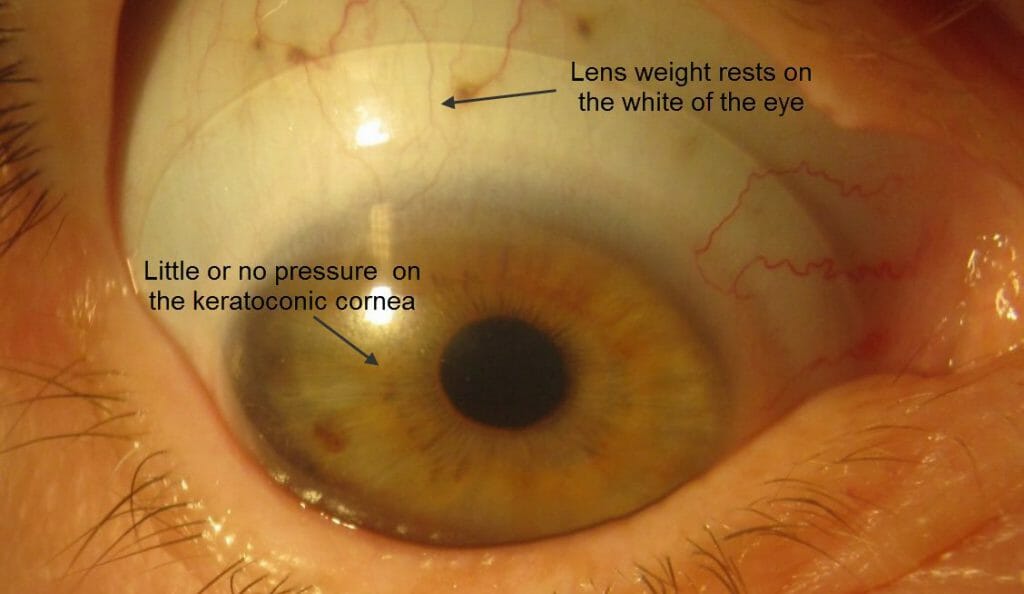 keratoconus contact lens